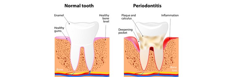 periodontal-gum-desease