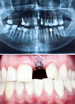 dental_implant_content_img