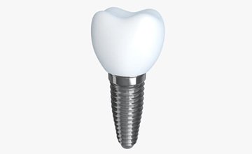 dental-implant