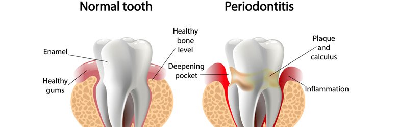 periodontal-gum-desease