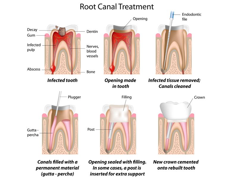 Root Canal Treatment Procedure