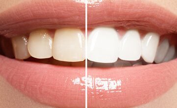 teeth-whitening-1