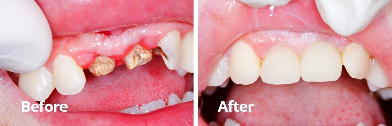 Before After Cosmetic Dentistry