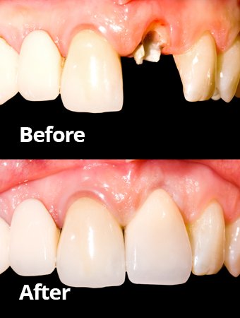 Before After Dental Crowns