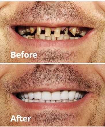 Before After Cosmetic Dentistry