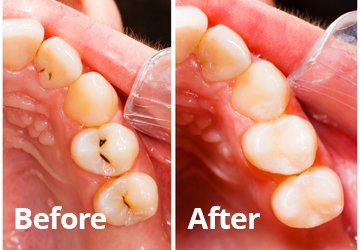 Before After Dental Fillings