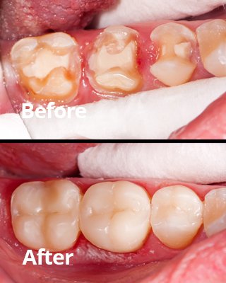 Before After Inlays