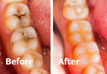 Before After Dental Fillings