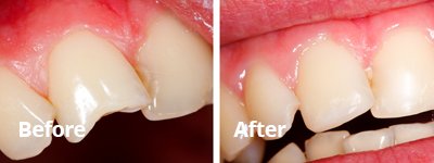 Before After White Fillings