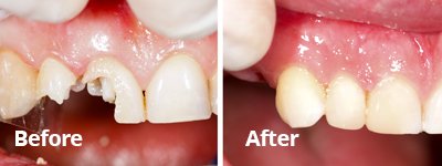 Before After White Fillings