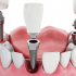 Give Your Teeth a Second Chance with Dental Implant