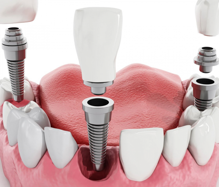 Give Your Teeth a Second Chance with Dental Implant