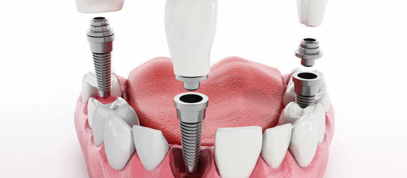 Give Your Teeth a Second Chance with Dental Implant
